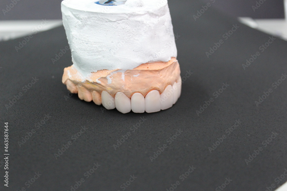 A dental bridge made of zirconia material that is made by a technician for the dentist to put on the patient. A dental bridge made of zirconia material that is made by a technician for the dentist to put on the patient.