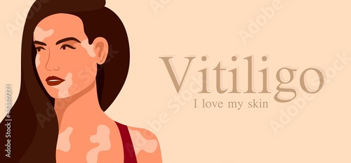 Vitiligo is a young woman with skin problems. Skin diseases. The concept of World Vitiligo Day. Different skin colors of female characters. For a blog, articles, banner, magazine.