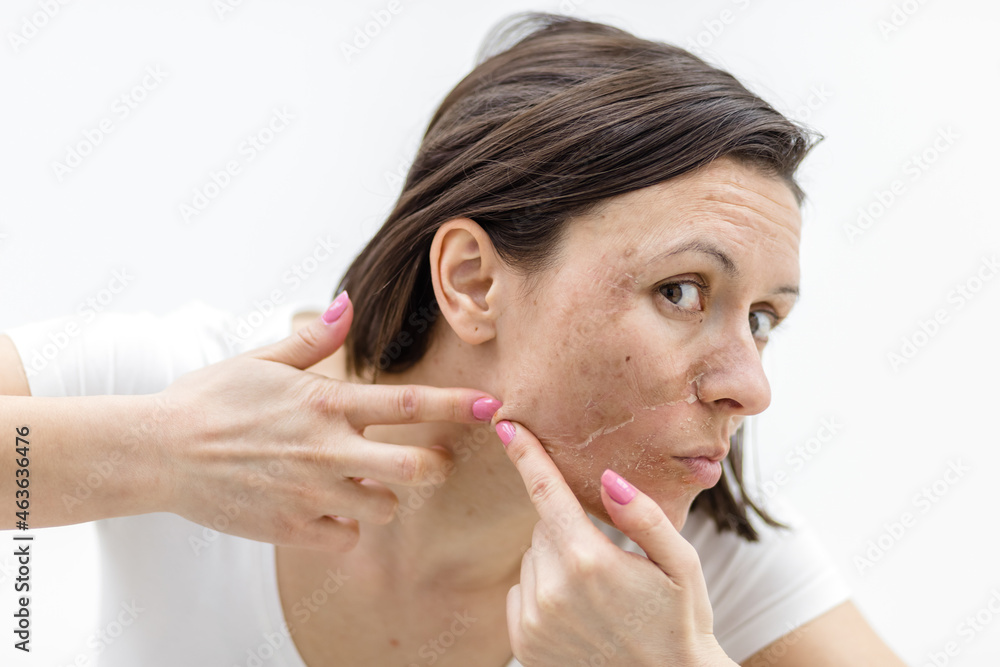 Photo of woman with acne problem squeezing pimple indoors. Photo of woman with acne problem squeezing pimple indoors.