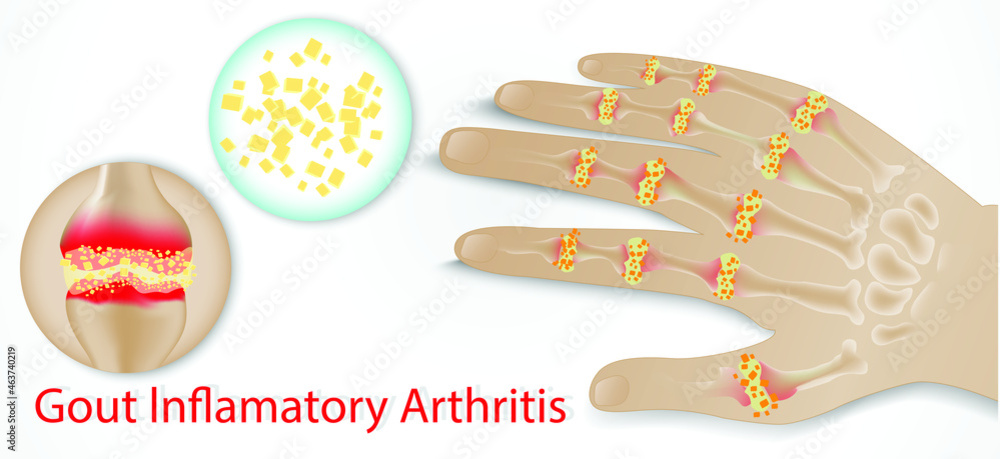Illustration of Gout disease in Human, Auto immune disorder in humans ...