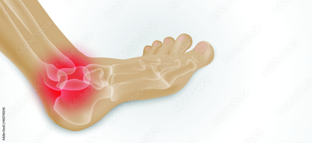 Illustration of Arthritis joint . Rheumatoid arthritis. Pain in leg. Human bone anatomy flat vector illustration. Painful injury erosion on a white background. Illustration of Arthritis joint . Rheumatoid arthritis. Pain in leg. Human bone anatomy flat vector illustration. Painful injury erosion on a white background.