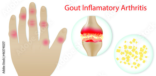 Illustration of Gout disease in Human, Auto immune disorder in humans. joint pain.Medical illustration of the symptoms of gout.