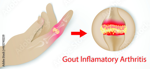 Illustration of Gout disease in Human, Auto immune disorder in humans. joint pain.Medical illustration of the symptoms of gout.
