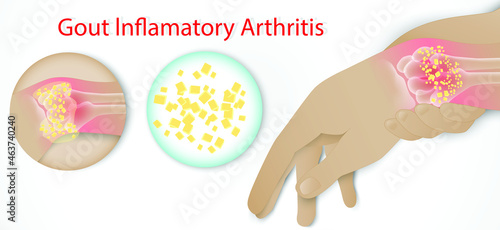 Illustration of Gout disease in Human, Auto immune disorder in humans. joint pain. Medical illustration of the symptoms of gout.