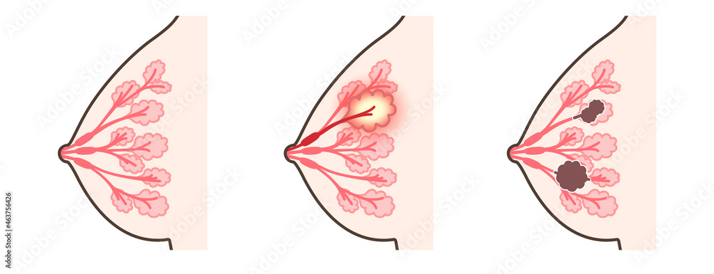 乳腺 乳腺炎 乳がん イラスト Stock イラスト Adobe Stock