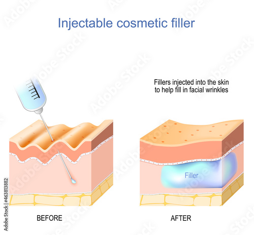 cosmetic filler injectable. Skin with wrinkles before and after