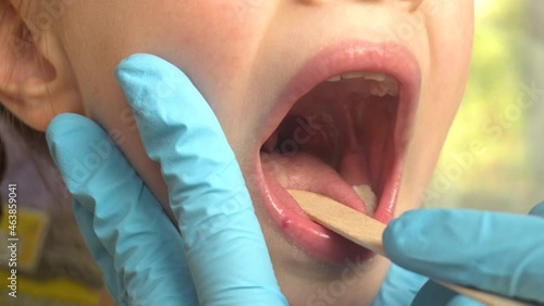 Close-up of a doctor examining a child's mouth and throat using a tongue depressor.ENT medicine.4k