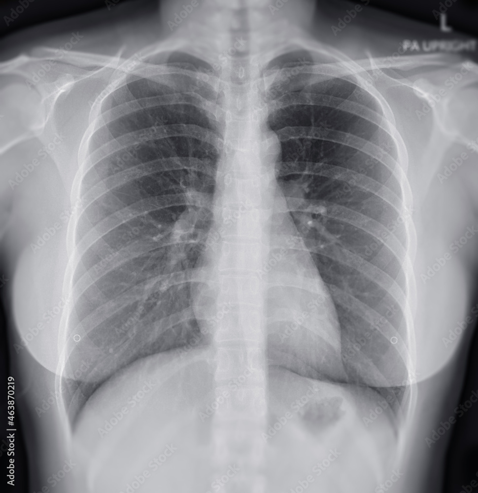 Chest X-ray Of Human Chest or Lung showing normal lung. Chest X-ray Of Human Chest or Lung showing normal lung.