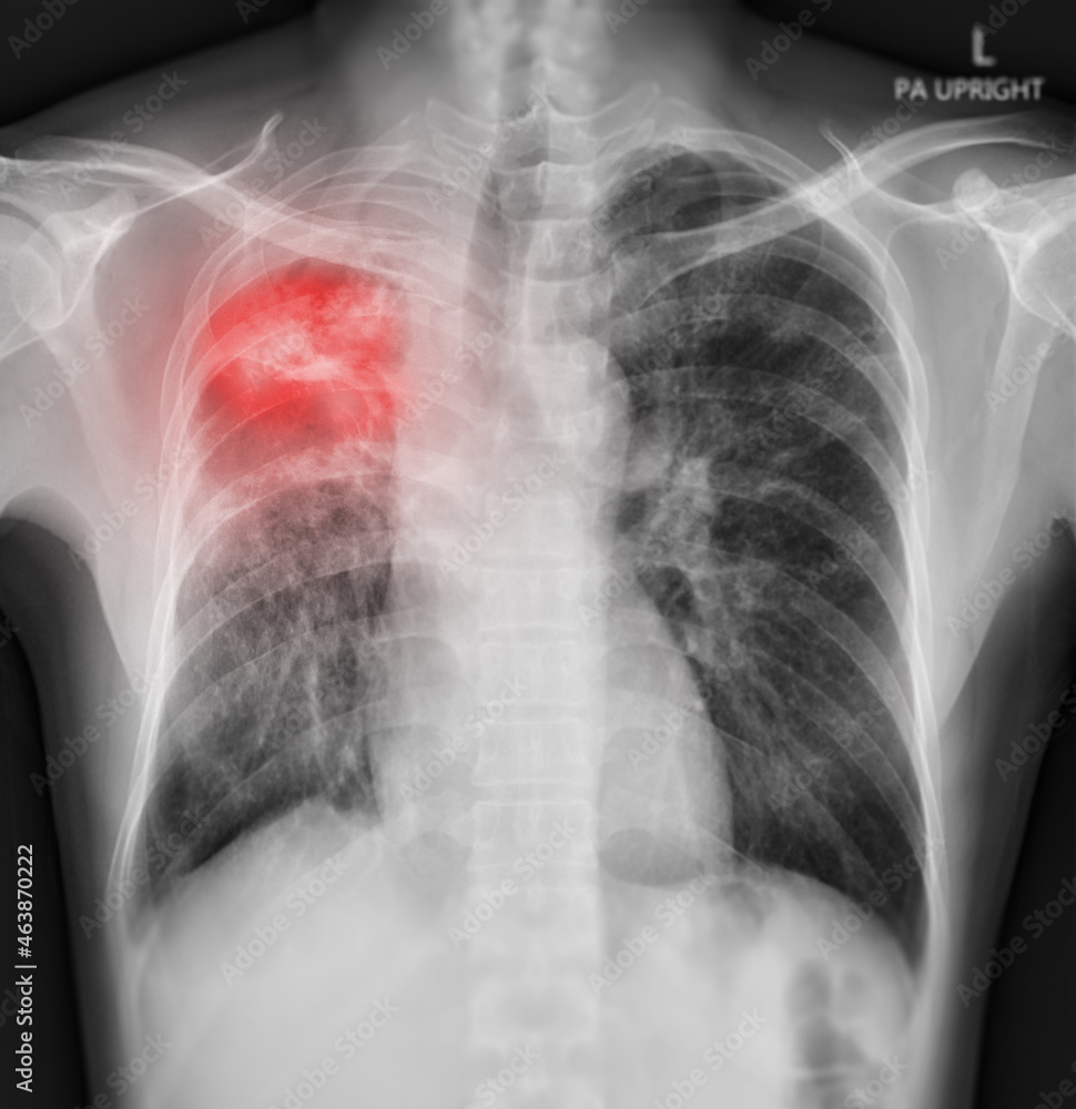 Chest X-ray Of Human Chest or Lung showing lung after detect corona virus 2019. Chest X-ray Of Human Chest or Lung showing lung after detect corona virus 2019.