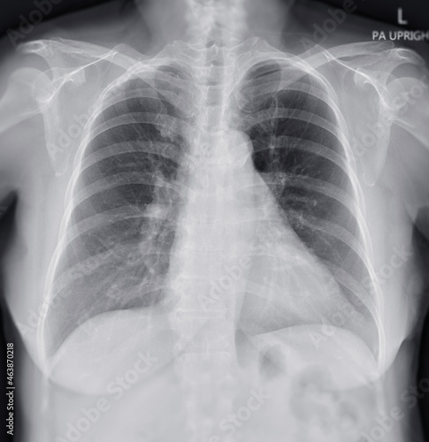 Chest X-ray Of Human Chest or Lung  showing normal lung. photo