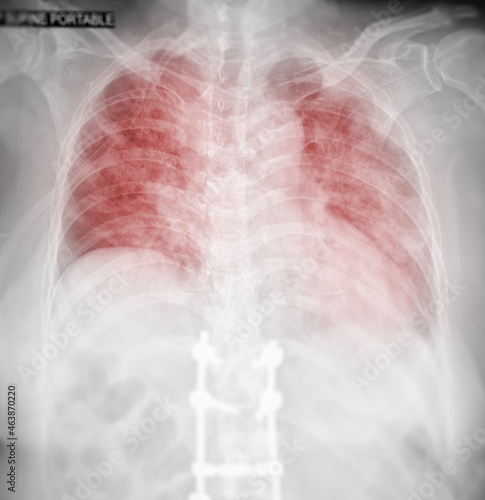 Chest X-ray Of Human Chest or Lung showing lung after detect corona virus 2019.