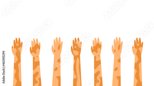 Flat Human Hands With Spots Vitiligo Depigmentation Disease Vector Design Style Concept People Are Equal