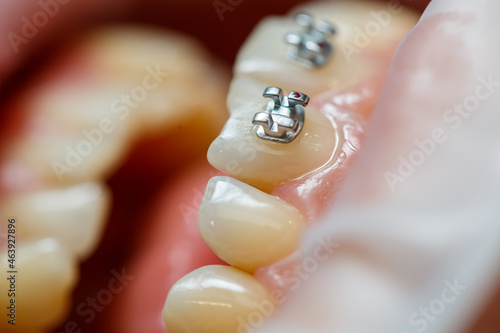 The orthodontist puts metal braces on the patient's teeth. Orthodontic dental treatment. High quality photo photo
