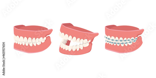 Human Jaw set isolated on white background. Opened, closed jaws and jaws with braces. Dental model of human jaws. Healthy oral hygiene. Trendy graphic for stomatology, dentist. Vector illustration
