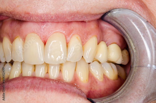 veneers on the middle incisors after inserting