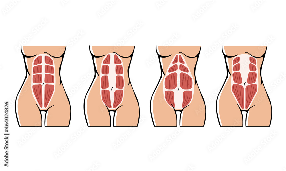 Different types of Diastasis. Diastasis in a woman after pregnancy. Woman  anatomy. Muscle corset of a woman after childbirth. Vector illustration  Stock Vector