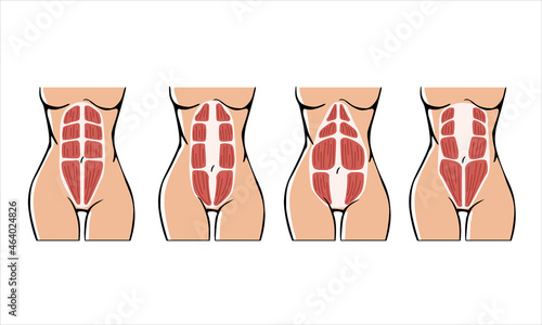 Different types of Diastasis. Diastasis in a woman after pregnancy. Woman anatomy. Muscle corset of a woman after childbirth. Vector illustration