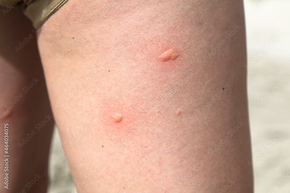 Mosquito bite on woman's leg Mosquito bite on woman's leg