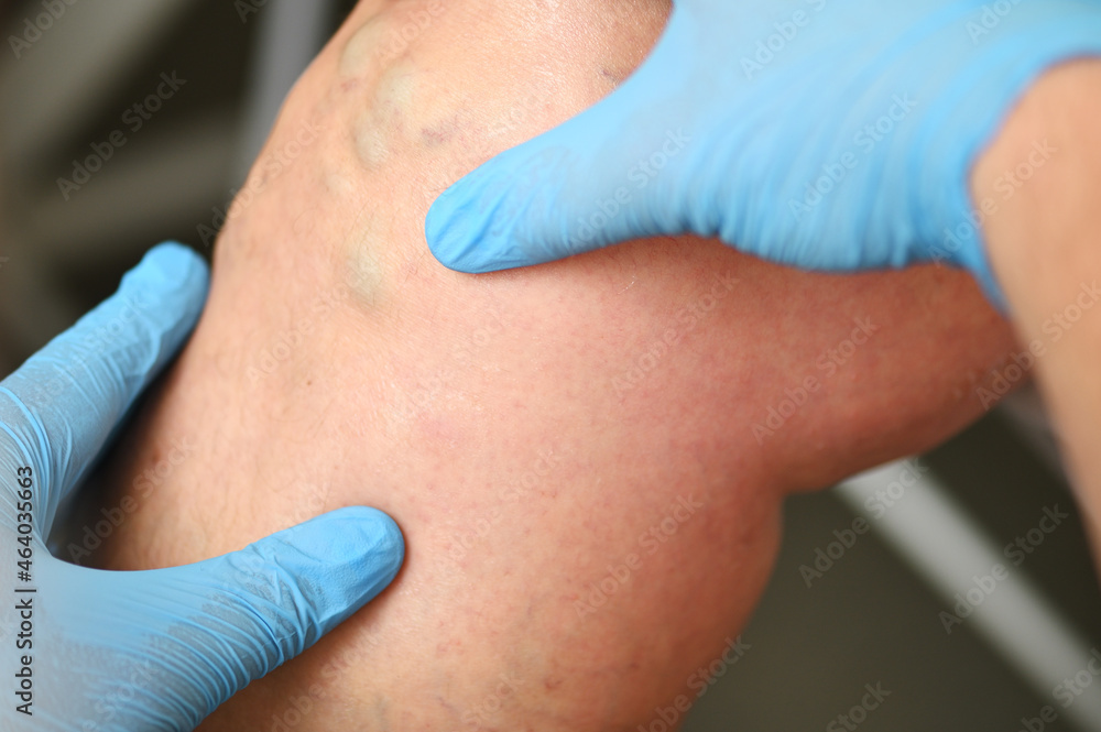 a phlebologist examines a patient with varicose veins on his leg. phlebology - study of venous pathologies of the lower extremities a phlebologist examines a patient with varicose veins on his leg. phlebology - study of venous pathologies of the lower extremities