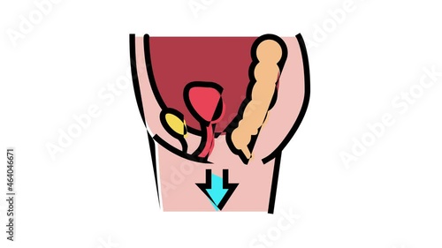 organ prolapse disease animated color icon. organ prolapse disease sign. isolated on white background photo