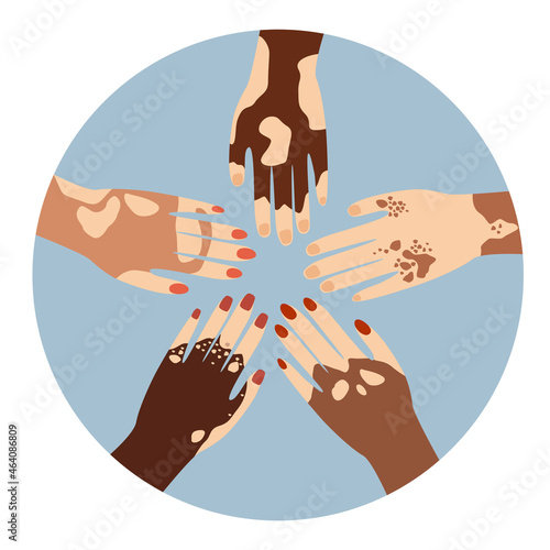 Hands different ethnicities in various gestures with skin disease. Depigmentation problem. Patchy loss of derma color. White spots. Human Solidarity.