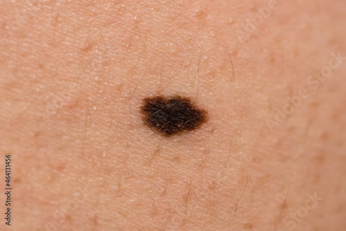 Suspicious mole on skin. Brown birthmark (nevus) on caucasian woman skin