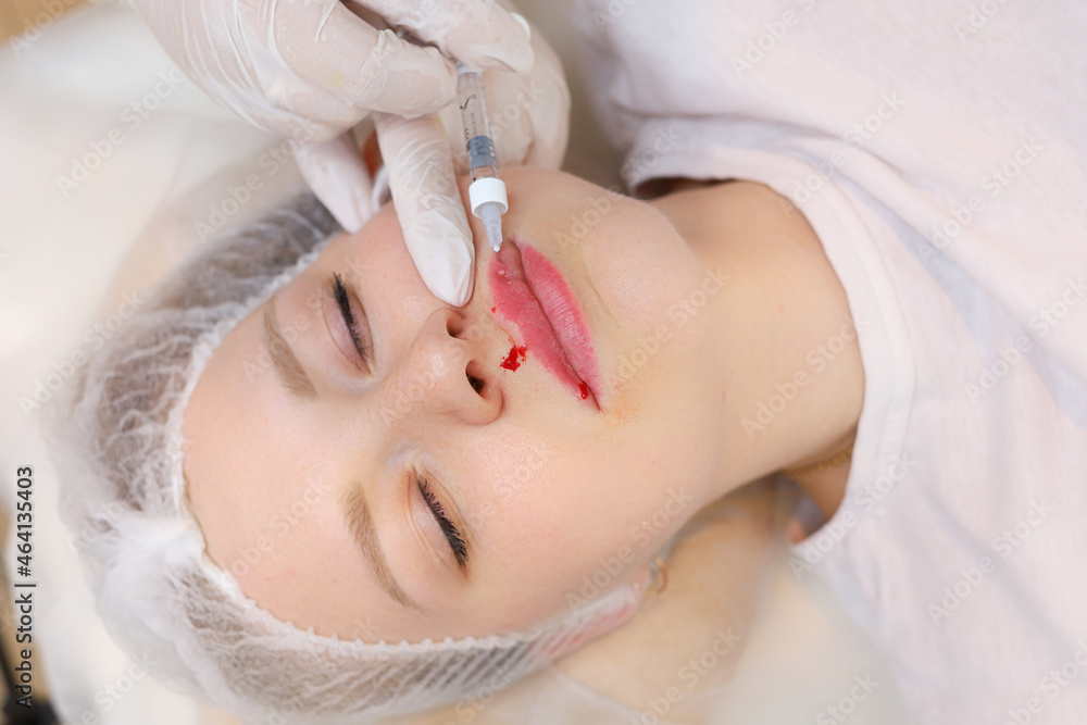 The beautician inserted a needle from the syringe all the way to its base to evenly distribute the hyaluronic acid in the client's lips The beautician inserted a needle from the syringe all the way to its base to evenly distribute the hyaluronic acid in the client's lips