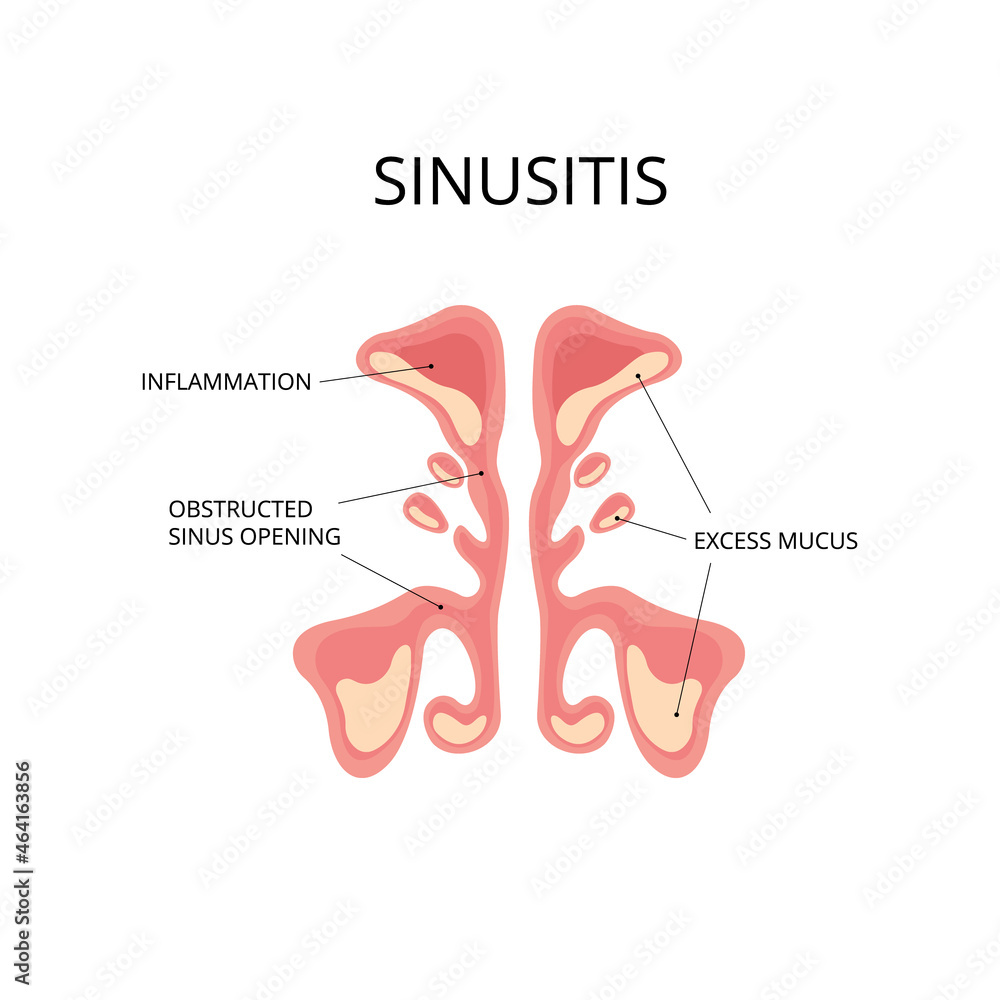 Inflammated sinus with excess mucus and obstrusted sinus openings. Infection, nasal disease, anatomy. Can be used for topics like diagnosis, congestion, flu Inflammated sinus with excess mucus and obstrusted sinus openings. Infection, nasal disease, anatomy. Can be used for topics like diagnosis, congestion, flu