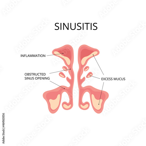 Inflammated sinus with excess mucus and obstrusted sinus openings. Infection, nasal disease, anatomy. Can be used for topics like diagnosis, congestion, flu