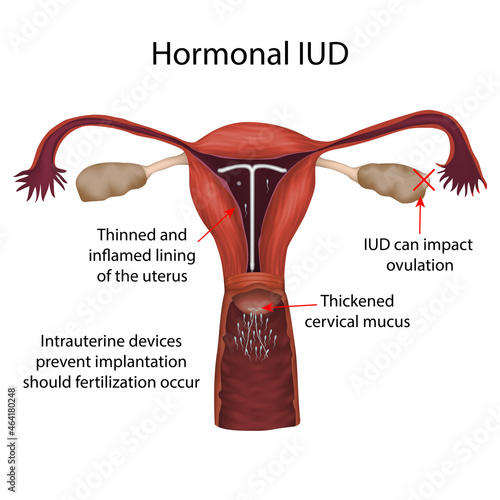 Hormonal IUD. Sperm, egg, uterus. Contraception methods. Vector medical illustration.
