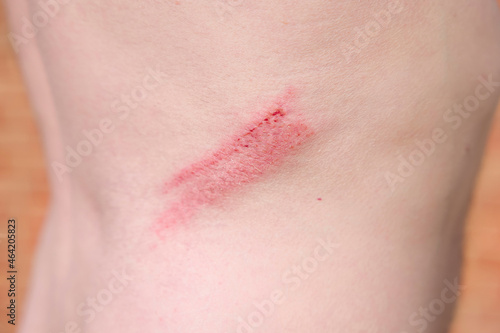 Grazed skin, abrasion on a man's back, UK