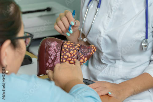 patient at doctor's appointment points to the model of the liver. doctor talks about the 4 stages of development of cirrhosis. photo