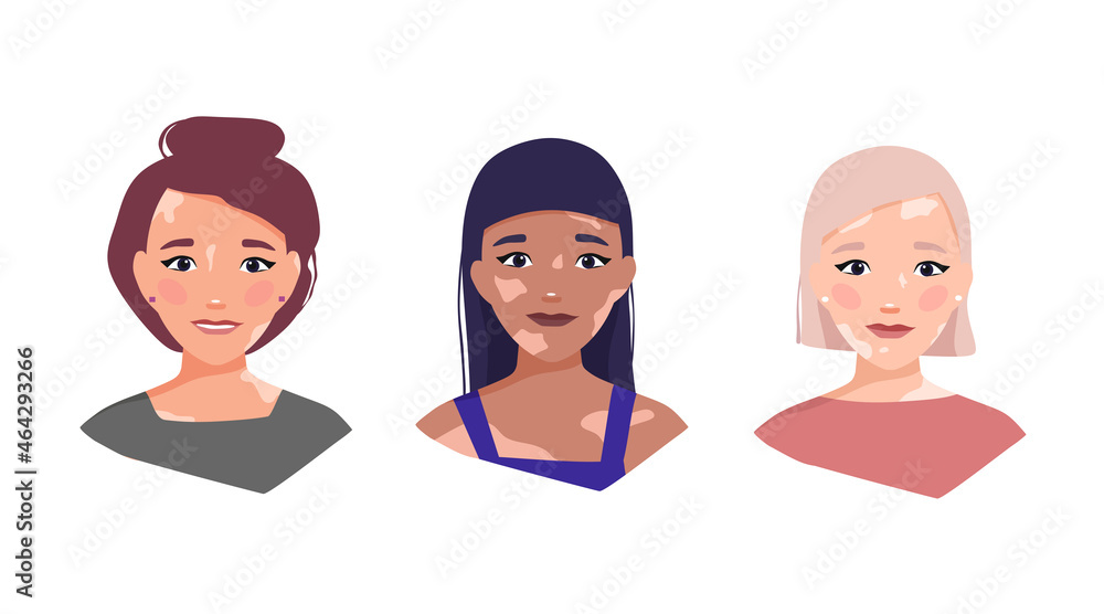 Girls with Vitiligo. The concept of different beauty, body positivity, self-acceptance. Skin disease. Vector cartoon illustration Girls with Vitiligo. The concept of different beauty, body positivity, self-acceptance. Skin disease. Vector cartoon illustration