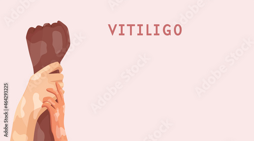 Hands with depigmentation. The concept of different beauty, self-acceptance. Skin diseases. Vector illustration of a cartoon. A banner with space for text