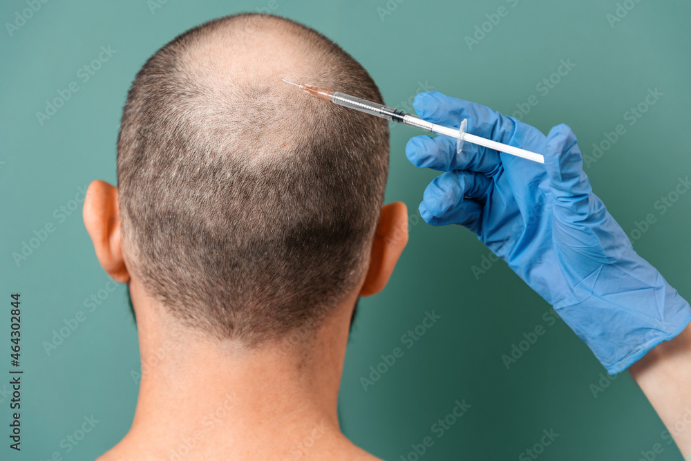 A man with alopecia on his head during a mesotherapy procedure with a trichologist. Back view. Turquoise background. The concept of baldness and professional treatment A man with alopecia on his head during a mesotherapy procedure with a trichologist. Back view. Turquoise background. The concept of baldness and professional treatment