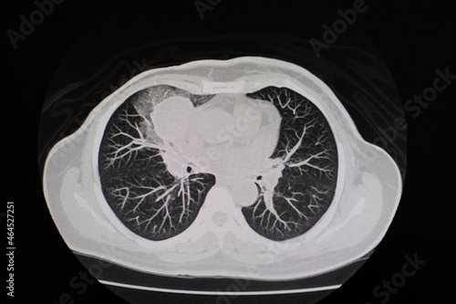 CT scan (computed tomography) of chest organs.