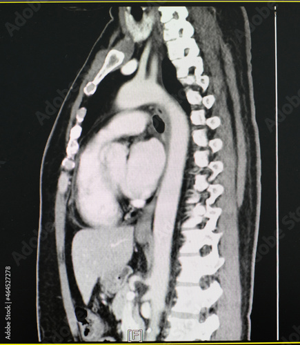 CT scan (computed tomography) of chest and abdominal organs.