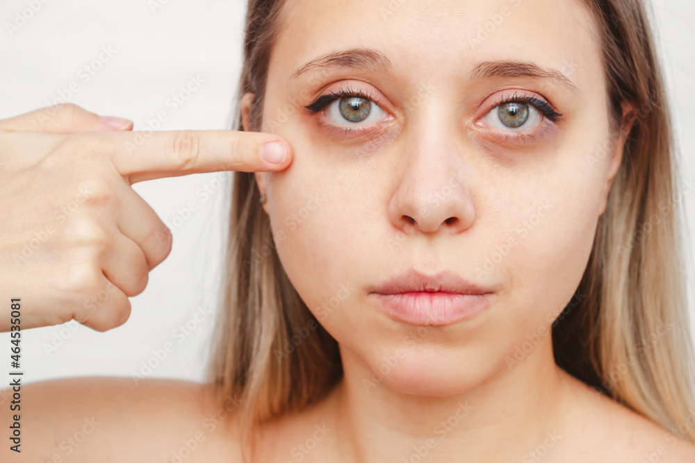 A young caucasian woman points dark circles under the eyes with her finger. Bruises under the eyes are caused by fatigue, nervousness, lack of sleep, insomnia and stress. Skin care, cosmetology A young caucasian woman points dark circles under the eyes with her finger. Bruises under the eyes are caused by fatigue, nervousness, lack of sleep, insomnia and stress. Skin care, cosmetology