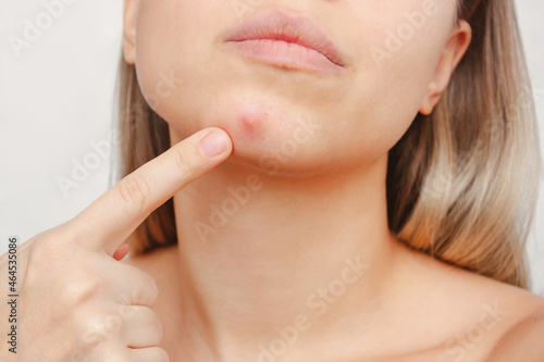 Cropped shot of a young woman pointing to a red inflamed pimple on her chin on a white background. The problem of acne on female face. Problem skin, care and beauty concept. Dermatology, cosmetology photo