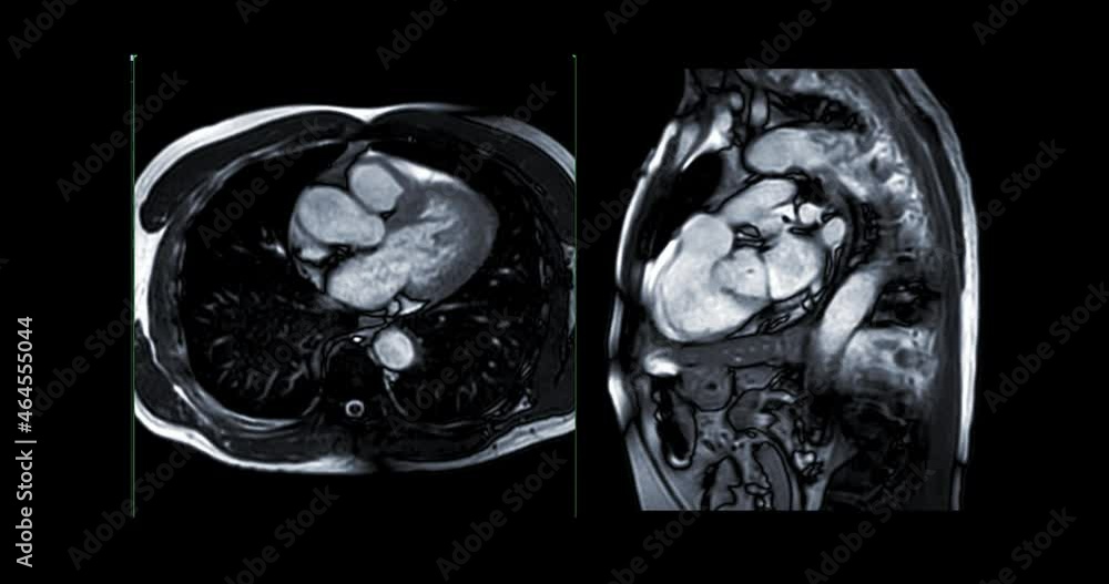 MRI heart or Cardiac MRI ( magnetic resonance imaging ) of heart showing heart beating for detecting heart disease. MRI heart or Cardiac MRI ( magnetic resonance imaging ) of heart showing heart beating for detecting heart disease.