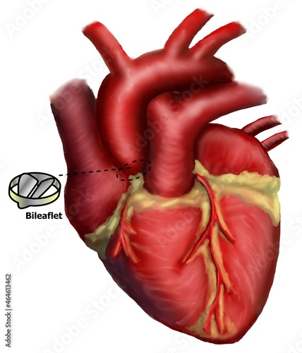 The cathergories of risk of thromboembolism in valvular heart diseased as high, moderate and low risk. photo
