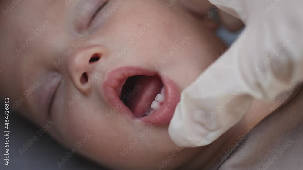 doctor dentist hands fingers in white gloves check sleeping caucasian baby infant first upper and low milk teeth eruption. kid child teething in swollen gums dentition in mouth doctor dentist hands fingers in white gloves check sleeping caucasian baby infant first upper and low milk teeth eruption. kid child teething in swollen gums dentition in mouth