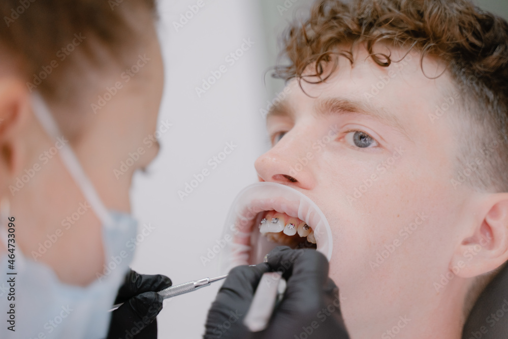 a patient with an open mouth and lips sits at an orthodontist's appointment, performs a brace