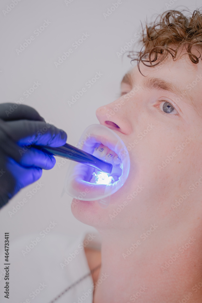 orthodontist shine an ultraviolet lamp on the braces for material hardening orthodontist shine an ultraviolet lamp on the braces for material hardening