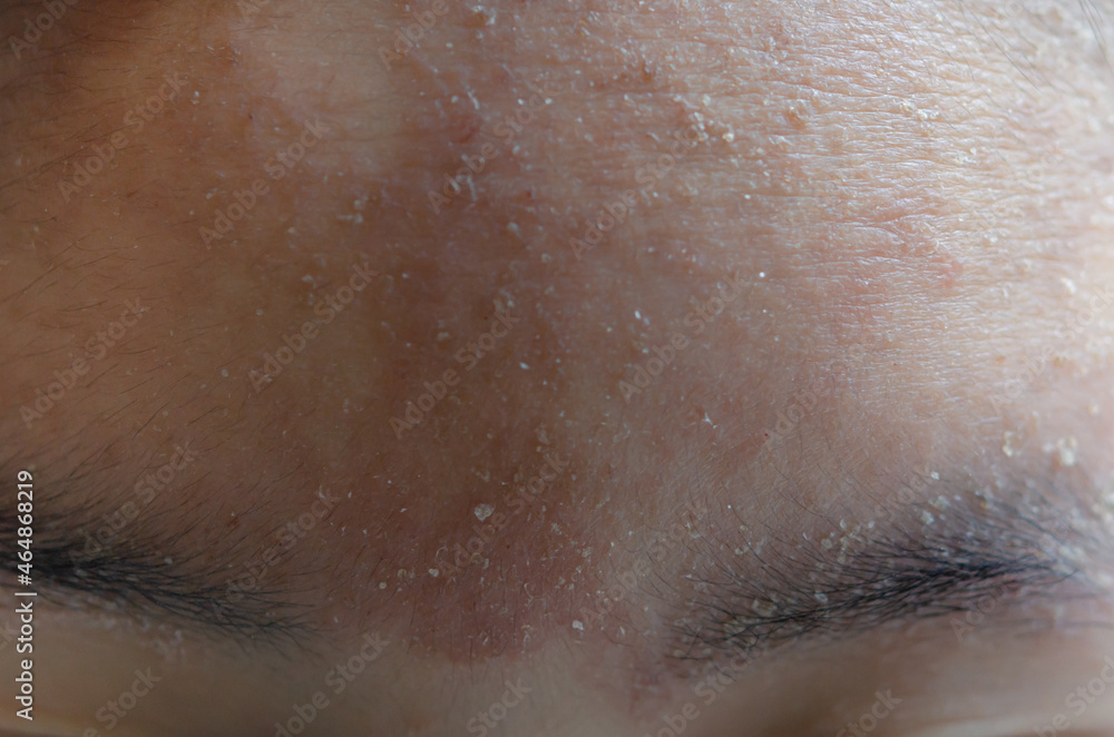 woman with symptom of atopic dermatitis on Forehead.
