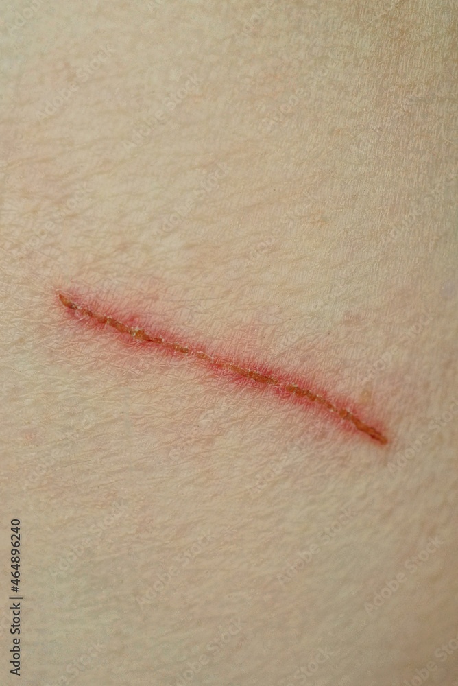 Fototapeta premium one red long scratch cut on gray skin of hand