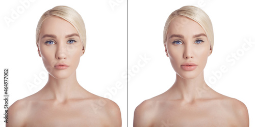 Fotografie Woman before after plastic surgery nose and lips