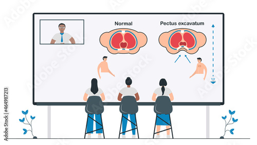 Students study about Pectus excavatum that is a structural deformity of anterior thoracic wall. Pulmonology vector illustration about restrictive lung disease.