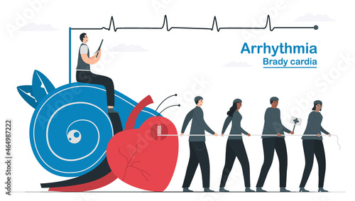 This heart disease problem is bradycardia arrhythmia. Diagnostic and analysis shows that periodic signal is slow impulse response around sinus node. Cardiology vector illustration.