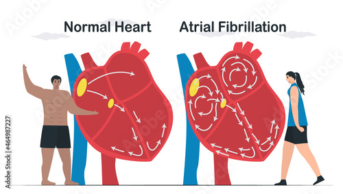 Data comparison of Normal heart and Atrial fibrillation. AF is common type of irregular heartbeat. Electrical signals in atrium cause atrium to beat quickly and erratically. cardiology vector.